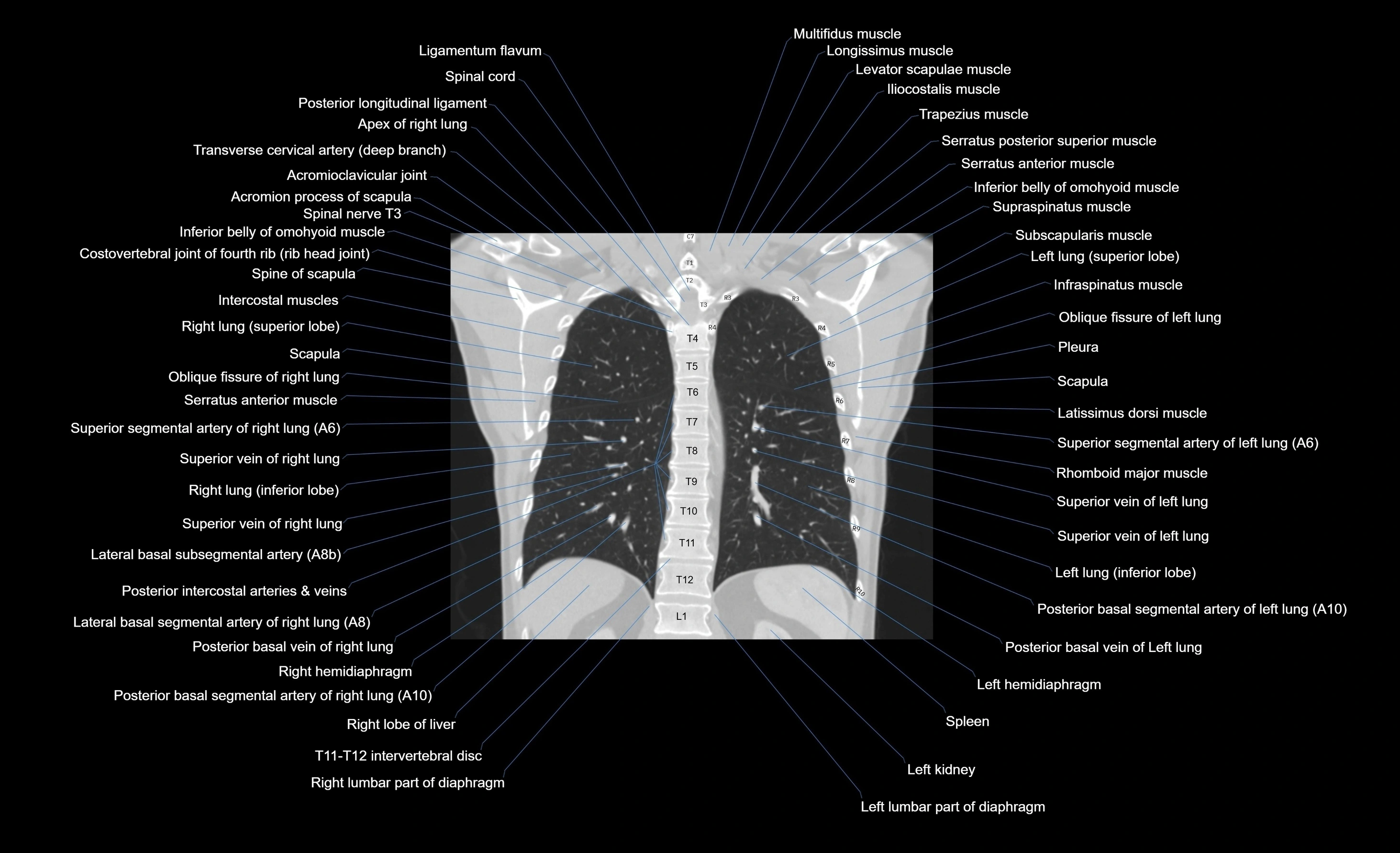 CT chest (thorax) labelled coronal cross sectional anatomy radiology image-00038.webp